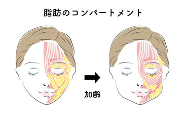顔のたるみに悩む女性、顔の脂肪のコンパートメント_加齢変化