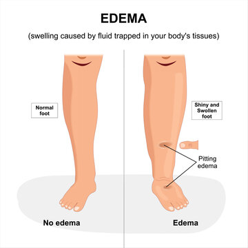 "Pitting Edema" Images – Browse 21,368 Stock Photos, Vectors, and Video