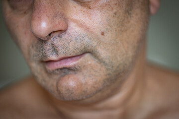 Close up of mature male face skin with age spots and a mole.
