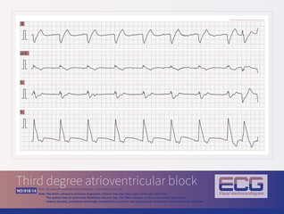 A patient with AIMI presents with a sudden widening of the QRS complex in the junctional escape rhythm, premature ventricular contractions, resulting in  polymorphic ventricular tachycardia.