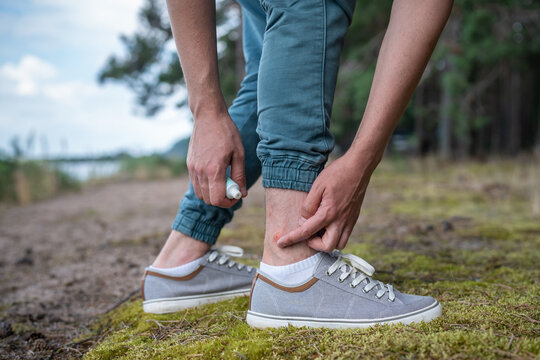 Man with mosquitoes bites, itching leg, applying treatment ointment on swell skin, suffering from allergic reaction. Individual intolerance to insect bites. Male attacked by gnats in forest at summer