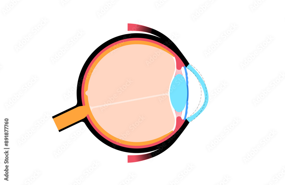 Sticker Cataract eye disease