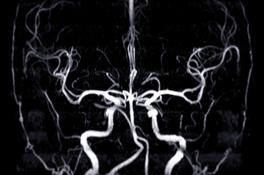 MRA Brain or Magnetic resonance angiography ( MRA )  of cerebral artery  for evaluate them  stenosis  and stroke disease.