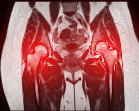 MRI scan of both hip joints reveals avascular necrosis of the femoral head.