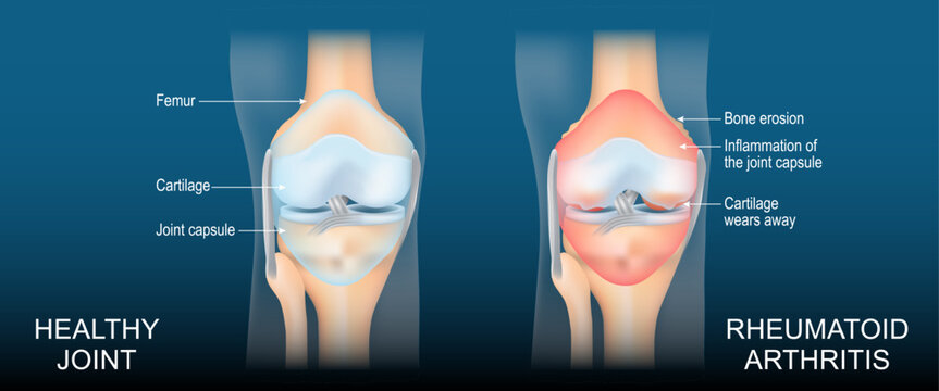 Rheumatoid arthritis