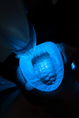 Teeth ultraviolet whitening process. Dentist is whitening teeth of his patient with ultraviolet...