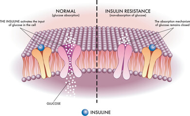 Medical illustration shows in a simple and schematic way the mechanism of insulin resistance, one of the causes of type 2 diabetes.
