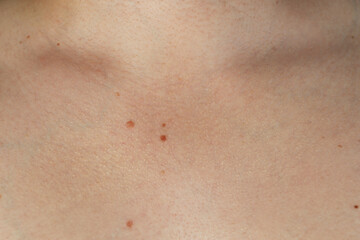 Fototapeta premium Man with birthmarks on his skin, closeup