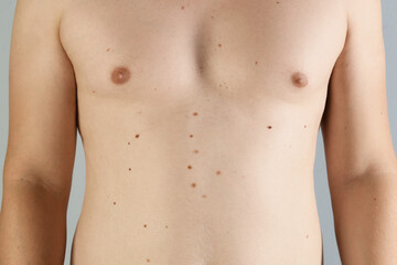 Fototapeta premium Man with birthmarks on his skin against grey background, closeup