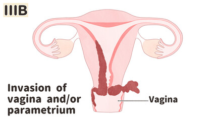 Endometrial cancer (Uterine cancer) Stage 3B diagram PNG