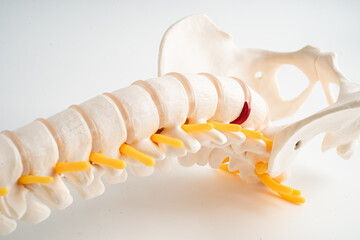 Fototapeta premium Lumbar spine displaced herniated disc fragment, spinal nerve and bone. Model for treatment medical in the orthopedic department.