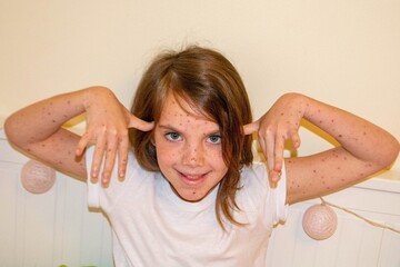 Natural vaccination. Contagious disease. Sick child with chickenpox. Varicella virus or Chickenpox...