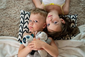 Natural vaccination. Contagious disease. Sick child with chickenpox. Varicella virus or Chickenpox...