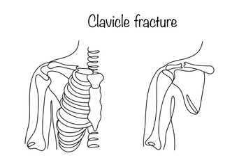 Clavicle fracture