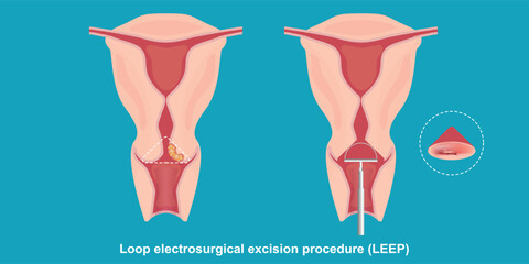 Loop electrosurgical excision procedure (LEEP) uses a wire loop heated by electric current.