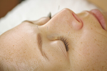 Naklejka premium Acupuncture