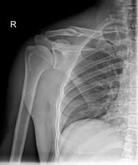 X-ray of shoulder joint show fracture clavicle