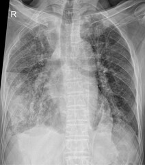 Analyzing Chest X-ray Features in Chronic Respiratory Conditions
