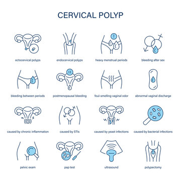 Cervical Polyp symptoms, diagnostic and treatment vector icons. Medical icons.