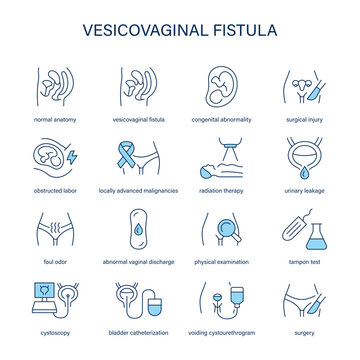 Vesicovaginal Fistula symptoms, diagnostic and treatment vector icons. Medical icons.