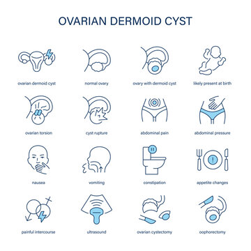 Ovarian Dermoid Cyst symptoms, diagnostic and treatment vector icons. Medical icons.