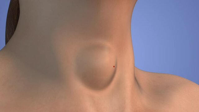 Thyroid nodule treatment medical animation