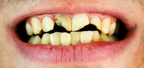 Broken, cracked front teeth in a man's mouth. Dental trauma, restoration, treatment close-up.