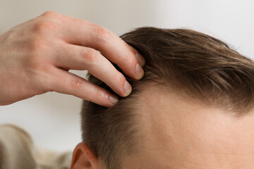Fototapeta premium Baldness concept. Man with receding hairline indoors, closeup