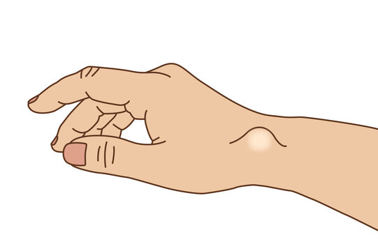 Ganglion cyst of the right wrist, illustration on white background