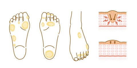 足裏と足の甲の魚の目とタコのイラストセット（女性の足・皮膚の断面図付き） © mw