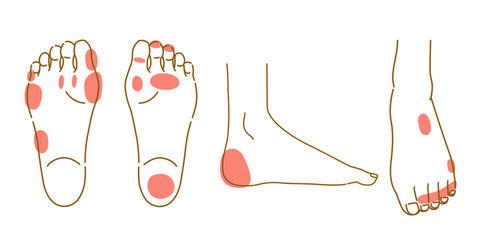 足裏と足の甲の魚の目とタコのイラストセット（女性の足） © mw
