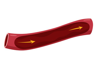 Atherosclerosis stage. Anatomy of heart attack. Arteriosclerotic vascular disease or ASVD. Atherosclerotic plaque in coronary artery. illustration on white background