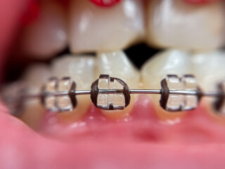 Dental braces super macro, crooked teeth, broken sapphire braces
