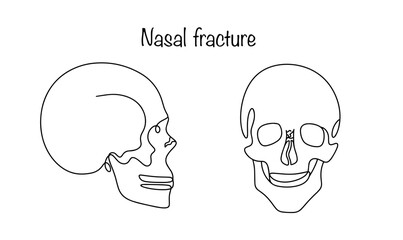 Nasal fracture