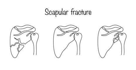 Scapular fracture