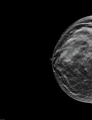 Mammogram. Right bilateral craniocaudal (CC) view (with tomosynthesis and C-view reconstruction), fibroglandular and lipomatous structure (ACR C), benign bilateral calcifications, breast cysts present