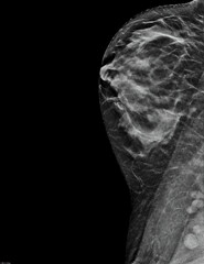 Mammogram. Left mediolateral oblique (MLO) view (with tomosynthesis and C-view reconstruction), fibroglandular and lipomatous structure (ACR C), benign bilateral calcifications, breast cysts present