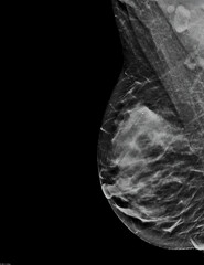 Mammogram. Right mediolateral oblique (MLO) view (with tomosynthesis and C-view reconstruction), fibroglandular and lipomatous structure (ACR C), benign bilateral calcifications, breast cysts present