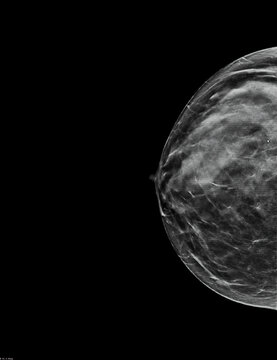 Mammogram. Right bilateral craniocaudal (CC) view (with tomosynthesis and C-view reconstruction), fibroglandular and lipomatous structure (ACR C), benign bilateral calcifications, breast cysts present