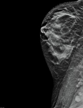 Mammogram. Left mediolateral oblique (MLO) view (with tomosynthesis and C-view reconstruction), fibroglandular and lipomatous structure (ACR C), benign bilateral calcifications, breast cysts present