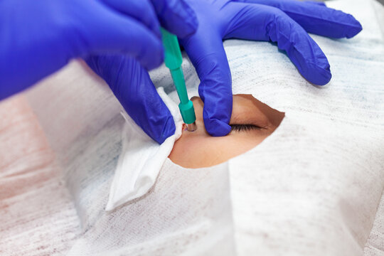 Skin lesion removal procedure. Dermatologist carrying out a removal of benign skin lesion on the face of a young male patient.