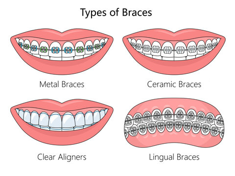 four types of dental braces. Orthodontic options for teeth straightening diagram hand drawn schematic vector illustration. Medical science educational illustration