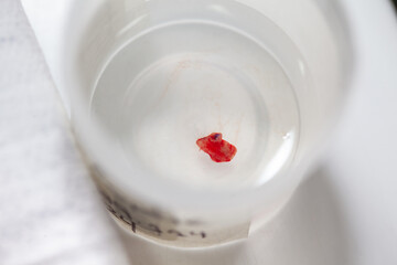 Container with an skin lesion removed from a patient. Dermatologist carrying out a removal of benign skin lesion on the face of a young male patient.