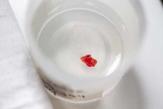 Container with an skin lesion removed from a patient. Dermatologist carrying out a removal of benign skin lesion on the face of a young male patient.