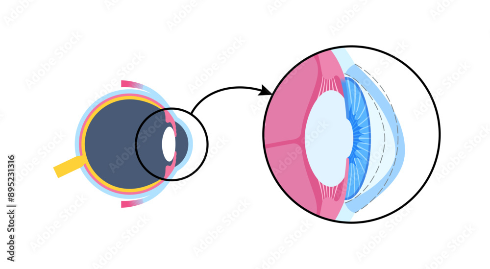 Sticker Cataract eye disease