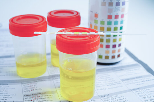 Urinalysis, urine cup with reagent strip pH paper test and comparison chart in laboratory.