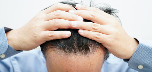 Fototapeta premium Bald head in man, hair loss treatment health problem.