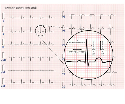十二誘導心電図 標準感度