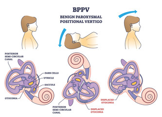 BPPV or benign paroxysmal positional vertigo syndrome outline diagram, transparent background. Labeled educational medical scheme with spinning and dizziness sensation cause illustration.