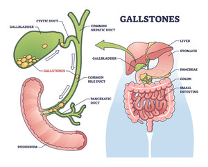 Gallstones as stones of cholesterol in gallbladder outline diagram, transparent background. Labeled educational scheme with bile ducts blockage and painful problem illustration.